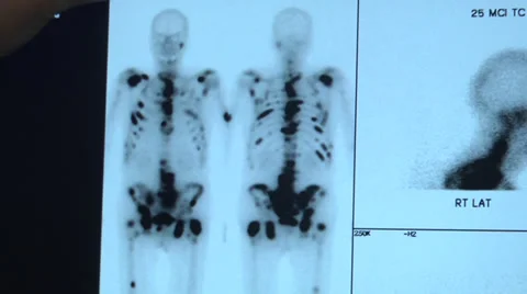 X-ray of patient with bone cancers Vidéo 33945076