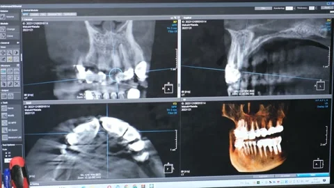 X-ray of the patient's face. Modern surgical dental clinic. Painless dental Vídeos de archivo 222773677