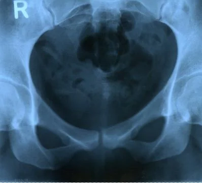 X-Ray of Pelvis Stock Photos