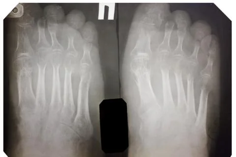 X-ray Photos