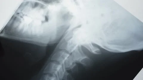 X-ray picture Stock Footage 163364815