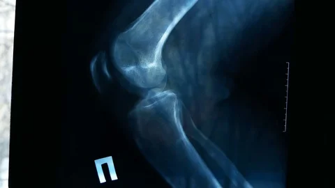 X-ray picture showing knee joints with arthrosis Stock Footage