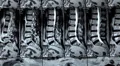 X-ray picture. X-ray of the spine HD Footage