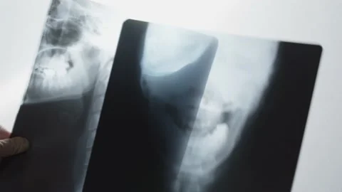 X-ray pictures Stock Footage 163364814