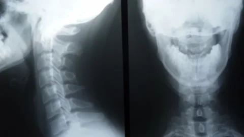 X-ray pictures Stock Footage 163364817