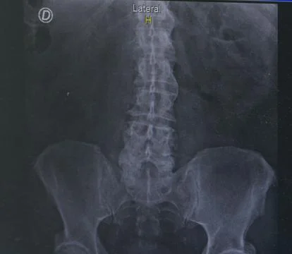 X-ray plate Back bone , vertebrae Stock Photos