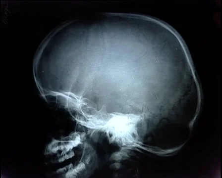 X-Ray profile2 Stock Footage 925528