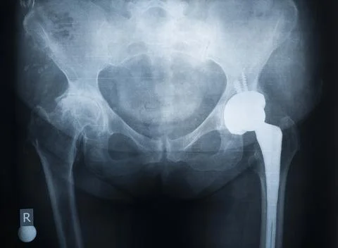 X-ray of the prosthesis of the left hip joint Stock Photos