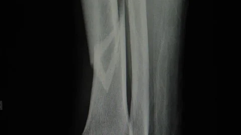 X Ray Radiography Of Tibia Bone Leg Frac Stock Video Pond