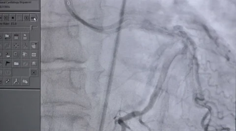 X-ray real heart beating in action on computer screen Video stock 65773144