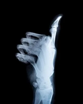 X-ray real scan thump up hand Stock Photos