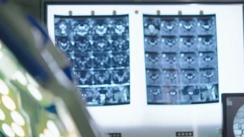 X-Ray reports displayed on x-ray illuminator board in hospital operation theatre Stock Footage 233964281