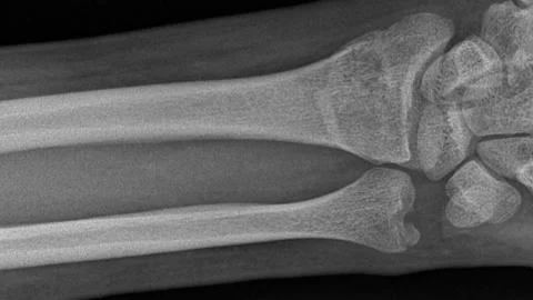 X-ray of the restored bones of the man's hand after breaking and removing 動画素材 135040789