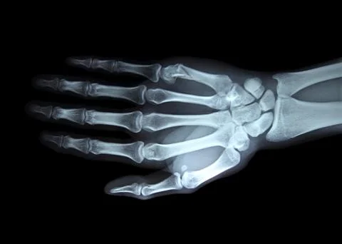 X-ray right hand Stock Photos