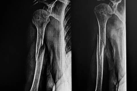 X- Ray of Right humerus bone fracture Stock Photos