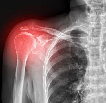 X-ray of right shoulder joints, front view. Stock Illustration