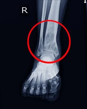 X-ray Rt.Ankle finding intramedullary osterolytic lesion of right distal tibi Stock Photos