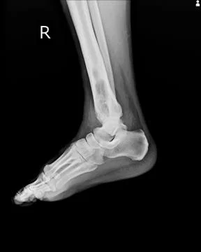 X-ray Rt.Ankle finding intramedullary osterolytic lesion of right distal tibi Stock Photos