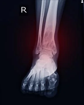 X-ray Rt.Ankle finding intramedullary osterolytic lesion of right distal tibi Stock Photos