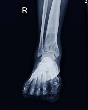X-ray Rt.Ankle finding intramedullary osterolytic lesion of right distal tibi Stock Photos