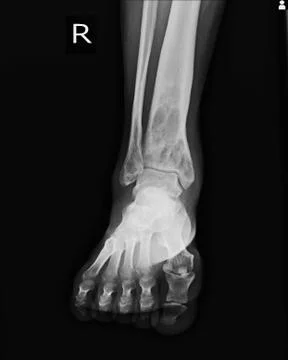 X-ray Rt.Ankle finding intramedullary osterolytic lesion of right distal tibi Stock Photos