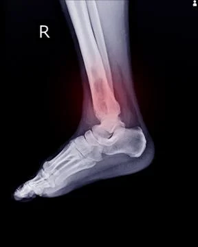 X-ray Rt.Ankle finding intramedullary osterolytic lesion of right distal tibi Stock Photos