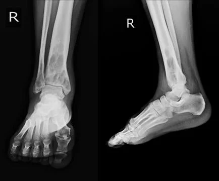 X-ray Rt.Ankle finding intramedullary osterolytic lesion of right distal tibi Stock Photos