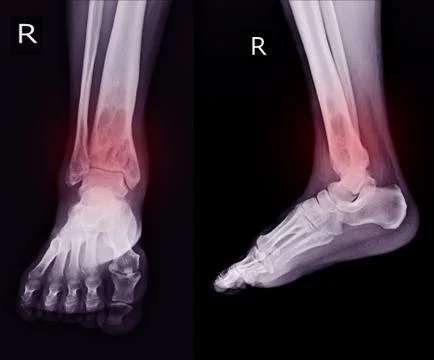 X-ray Rt.Ankle finding intramedullary osterolytic lesion of right distal tibi Stock Photos