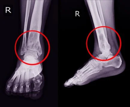 X-ray Rt.Ankle finding intramedullary osterolytic lesion of right distal tibi Stock Photos
