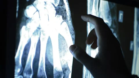 X-ray Scan Of A Broken Bone. Anatomy Inj... | Stock Video | Pond5