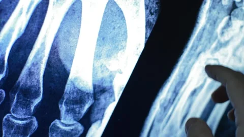 X ray scan of a broken bone in the hospital. black and blue x ray scan. Video stock 220845250