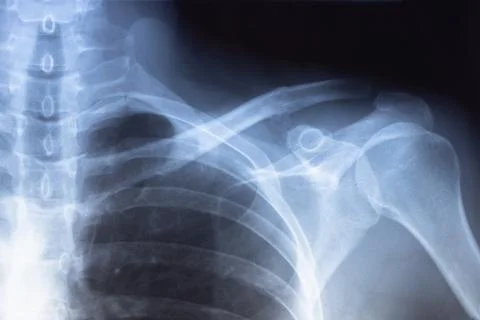 X-ray scan of  Dislocation of the acromial end of the clavicle. Stock Photos