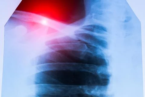 X-ray scan of  Dislocation of the acromial end of the clavicle. Stock Photos