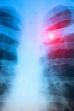 X-ray scan of  Dislocation of the acromial end of the clavicle. Stock Photos