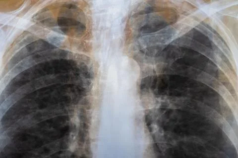 X-ray scan of Human bones disease. Spine cancer. Doctor learn diagnosis. Stock Photos