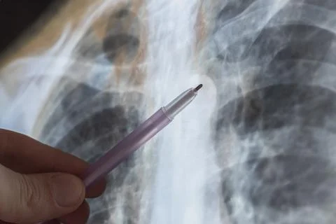 X-ray scan of Human bones disease. Spine cancer. Doctor learn diagnosis. Stock Photos