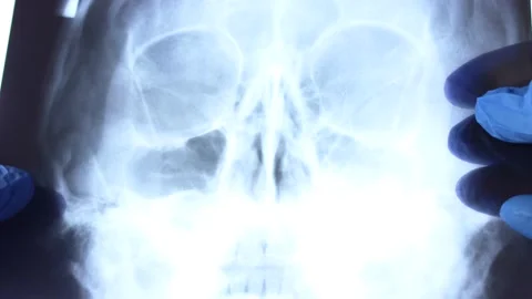 X ray scan of human skull in doctor hands. Ct head scanning on light background Stock Footage 238405021