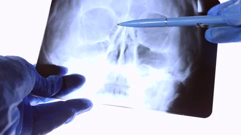 X ray scan of human skull in doctor hands with pointing pen Stock Footage 238621176