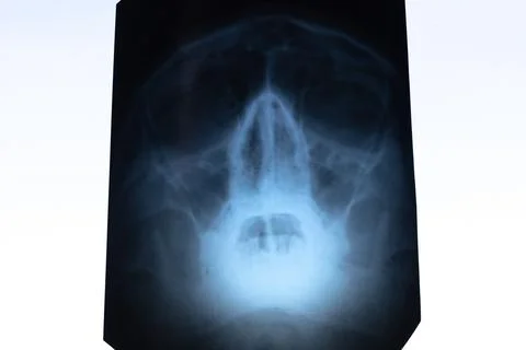 X-ray scan of a human skull. Deviated septum. Nasal septum, bone and cartil.. Stock Photos
