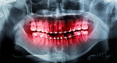 X-ray scan human for teeth Stock Photos