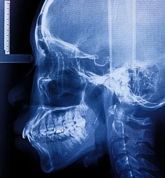 X-ray scan human for teeth Foto stock