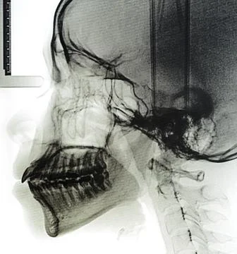 X-Ray scan human for teeth Stock Photos