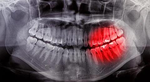 X-Ray scan human for teeth Stock Photos