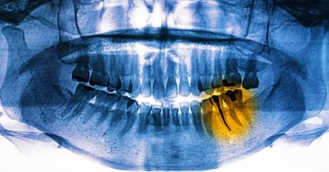 X-Ray scan human for teeth Stock Photos