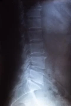 X-ray scan of intervertebral discs in spine. Close up. Stock Photos