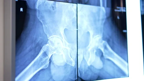 X-ray scan of the pelvic bones. Shot hanging on the screen at surgical room. Stock Footage 241124495