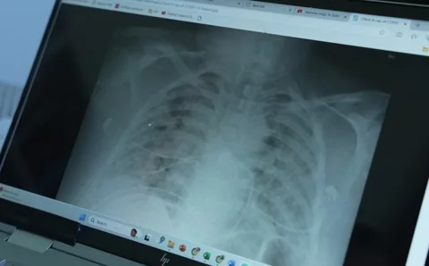 X-Ray on a Screen Stock Footage 296483791