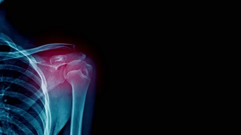 X ray of shoulder Stock Footage 148598826