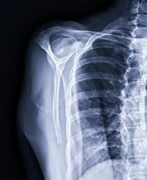 X-ray Shoulder joint shoulder front view for diagnosis fracture of shoulder.. Illustrazione stock