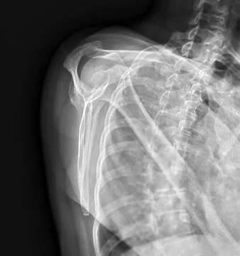 X-ray Shoulder joint shoulder front view for diagnosis fracture of shoulder.. Stock Illustration